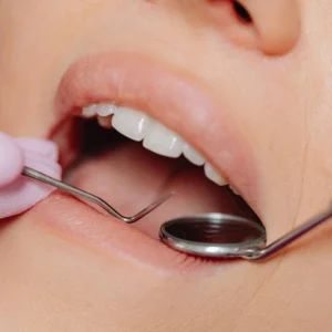 Blanqueamiento Dental